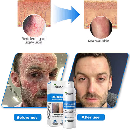 KUBOZN® Magnesium Herbal Spray – Fast Relief for Psoriasis & Eczema | No-Rub, Steroid-Free (IMPORTED)